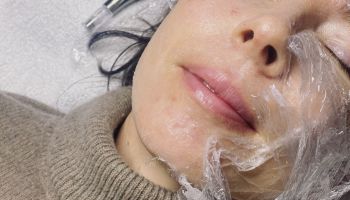 Mikrojehličkování je technika, díky které lze vyřešit téměř všechny problémy s pletí, říká dermato-estetický odborník Michal Seidl